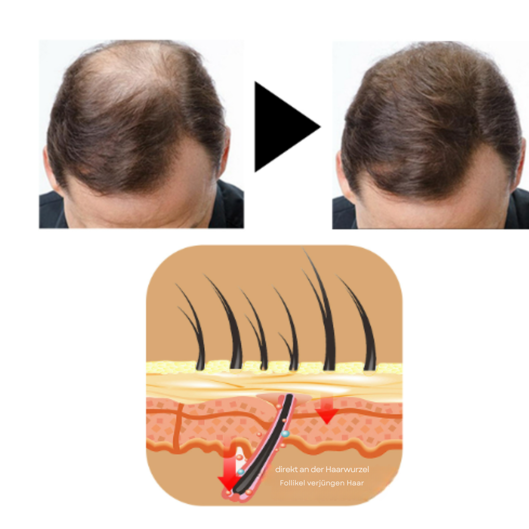 EastMoon™ | No more bald spots!